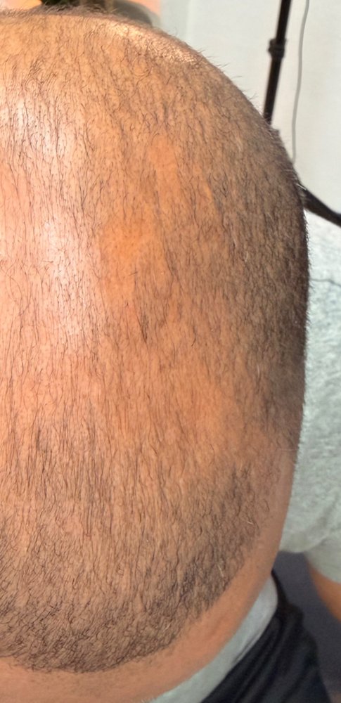 Before Root Authority treatment, top of scalp
