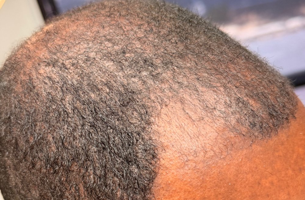 Before Root Authority treatment, top of scalp
