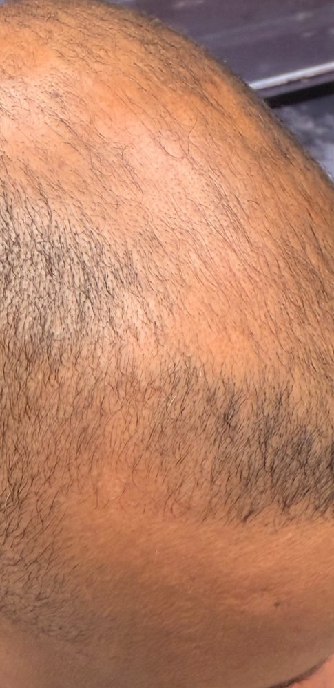 Before Root Authority treatment, crown and hairline