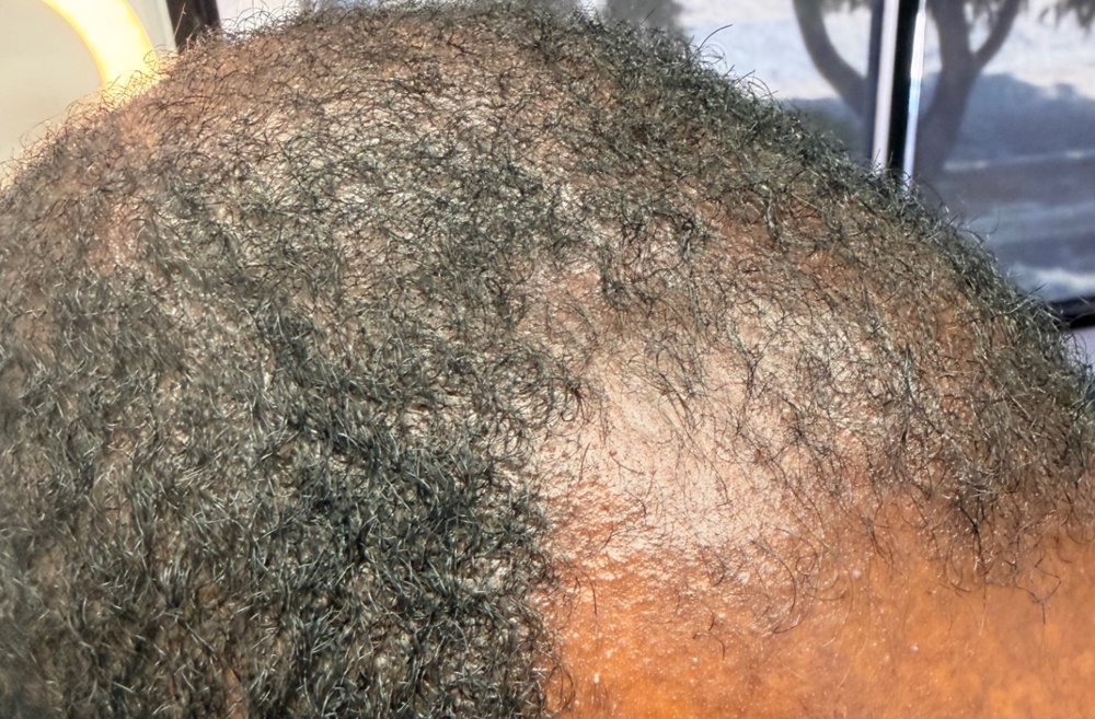 After Root Authority treatment, top of scalp