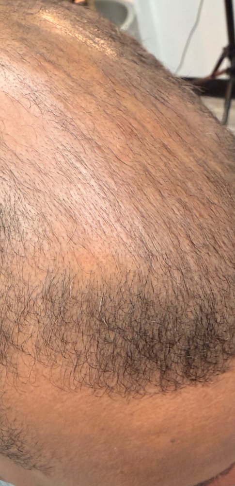After Root Authority treatment, crown and hairline