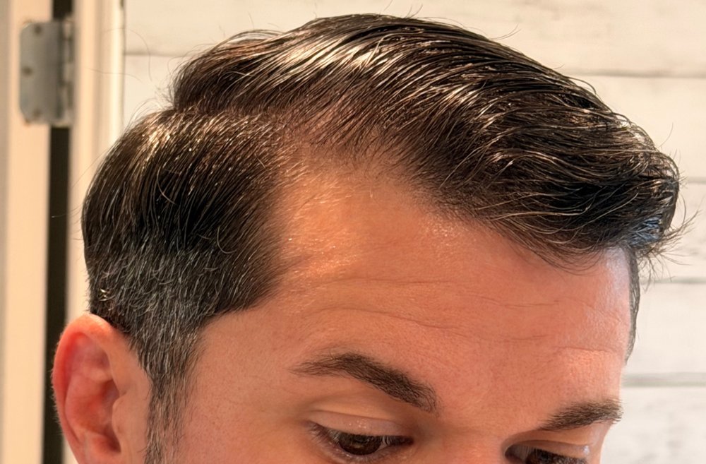 Before Root Authority treatment, hairline